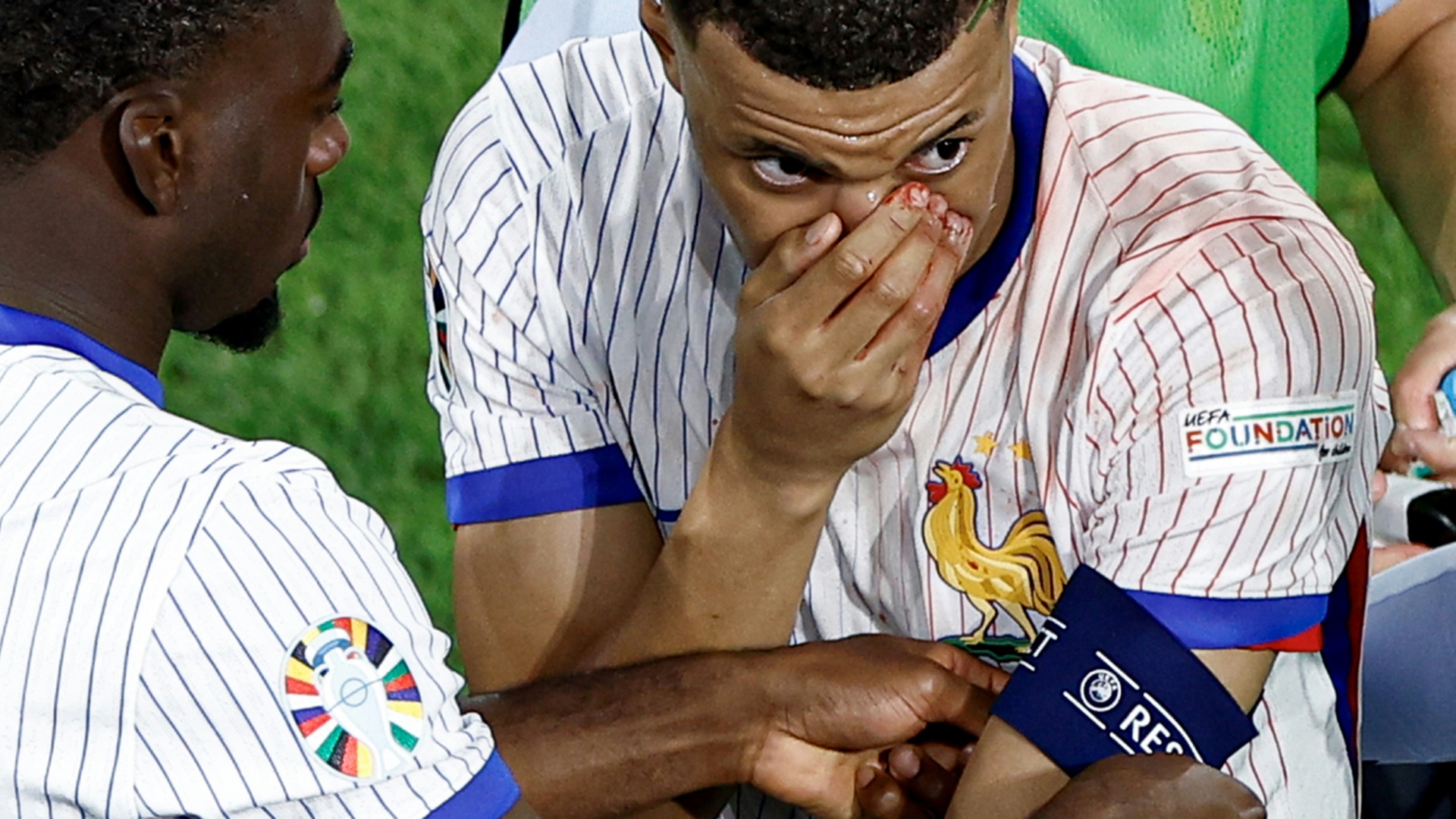 Mbappe erlitt gegen Österreich einen Nasenbeinbruch Mbappe erlitt gegen Österreich einen Nasenbeinbruch