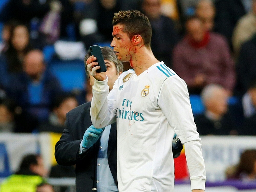 Ronaldo begutachtet seine Platzwunde mit dem Handy